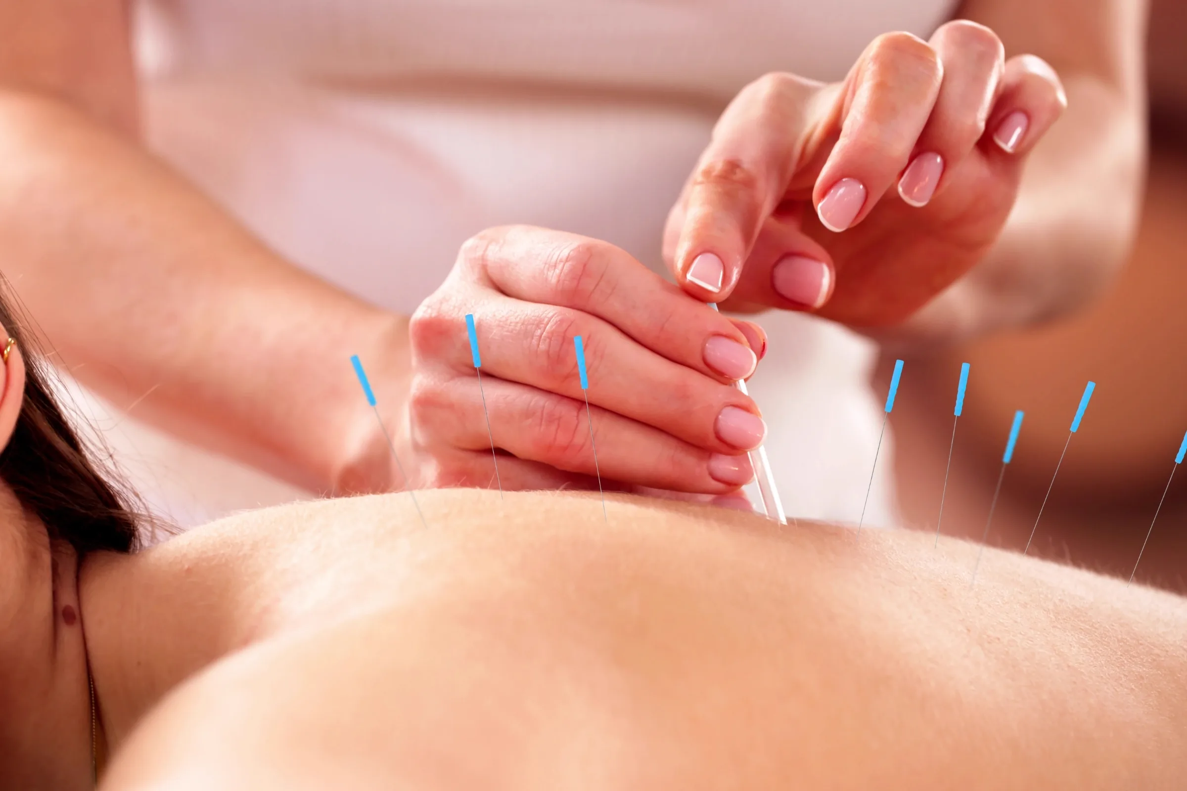 Acupuncture in Tolland