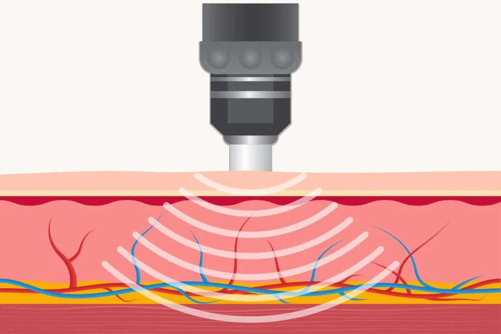 A Shockwave Therapy handpiece in use over the heel during a session in Tolland
