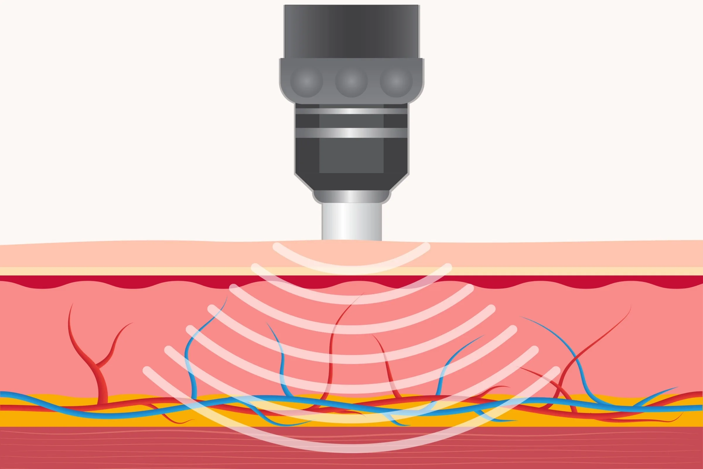 Shockwave Therapy in Tolland